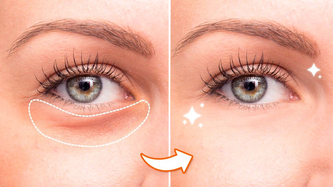 Can Glasses Make Under-Eye Bags Look Worse?
